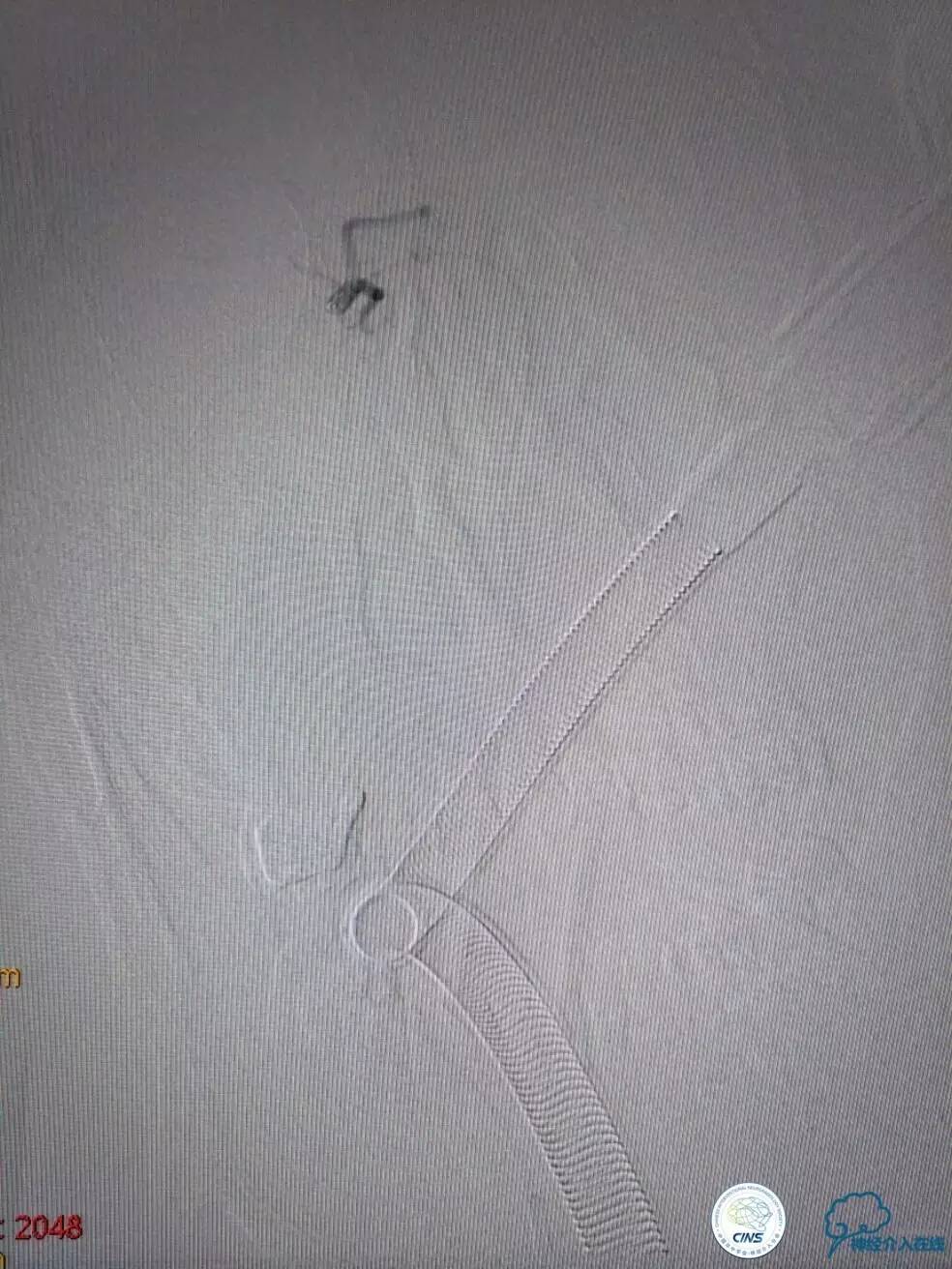 一例急性基底动脉尖综合征患者的支架取栓治疗