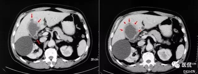消化系统钡餐造影的直接征象,消化系统影像学诊断手册基础知识