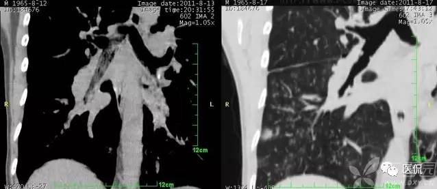影像学呼吸系统理论知识,呼吸系统疾病影像学常见征象