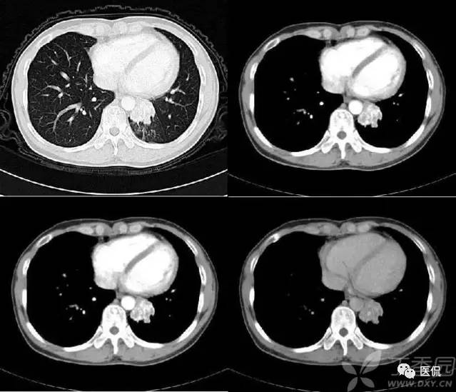 影像学呼吸系统理论知识,呼吸系统疾病影像学常见征象