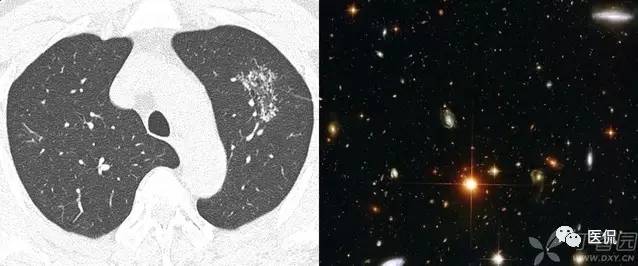 影像学呼吸系统理论知识,呼吸系统疾病影像学常见征象