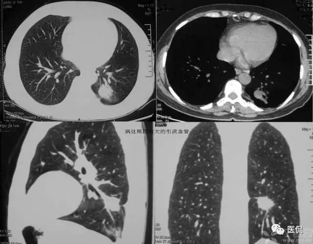 影像学呼吸系统理论知识,呼吸系统疾病影像学常见征象