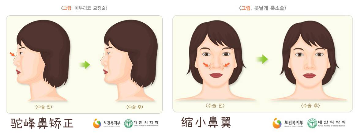 双眼皮手术韩式整形,韩国医生做幽灵手术