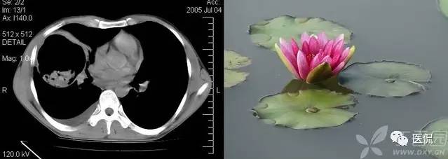 影像学呼吸系统理论知识,呼吸系统疾病影像学常见征象