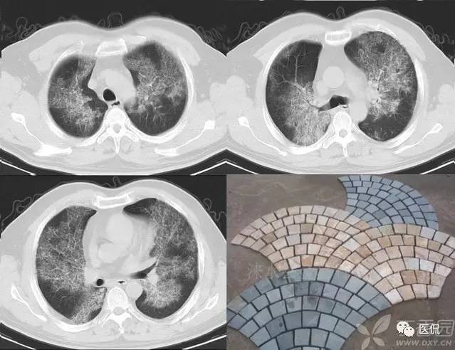 影像学呼吸系统理论知识,呼吸系统疾病影像学常见征象