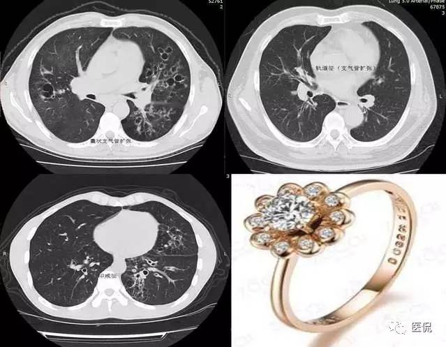 影像学呼吸系统理论知识,呼吸系统疾病影像学常见征象