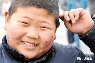 儿童脸上冻疮怎么处理,儿童冻疮怎么快速治疗最快最有效