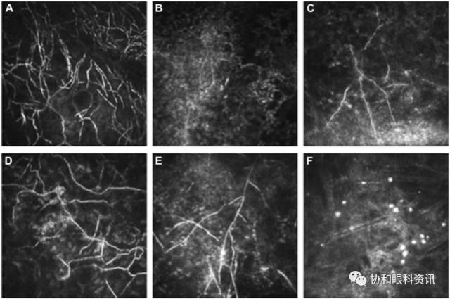 文摘速递丨共聚焦显微镜：角膜溃疡病原诊断的利器