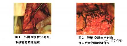 外科损伤胆管后的最佳处理方法,胆管损伤重建术式首选