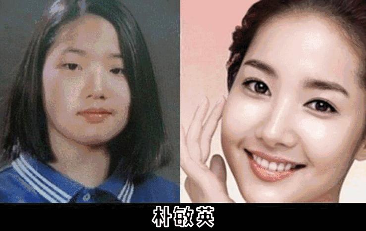 双眼皮手术韩式整形,韩国医生做幽灵手术