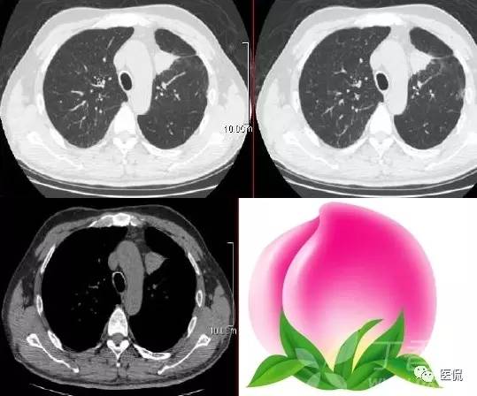 影像学呼吸系统理论知识,呼吸系统疾病影像学常见征象