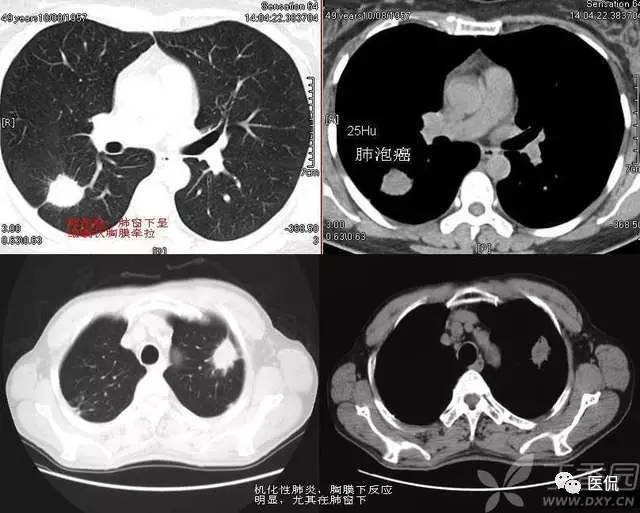 影像学呼吸系统理论知识,呼吸系统疾病影像学常见征象