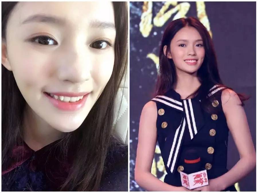 双眼皮手术韩式整形,韩国医生做幽灵手术