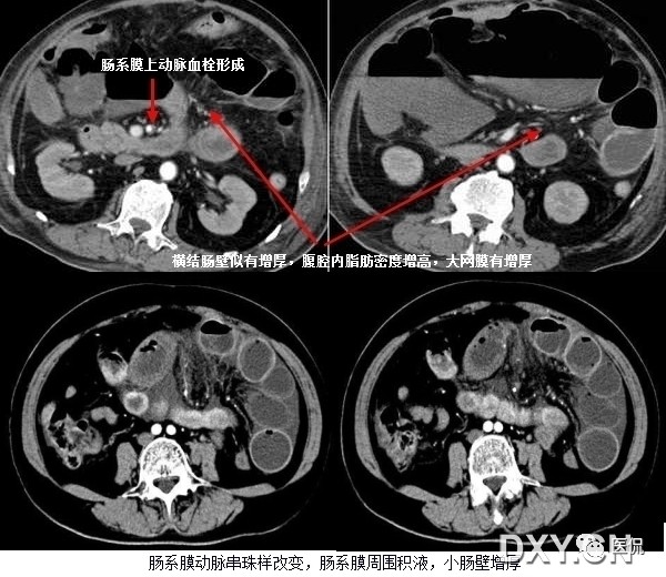 消化系统钡餐造影的直接征象,消化系统影像学诊断手册基础知识