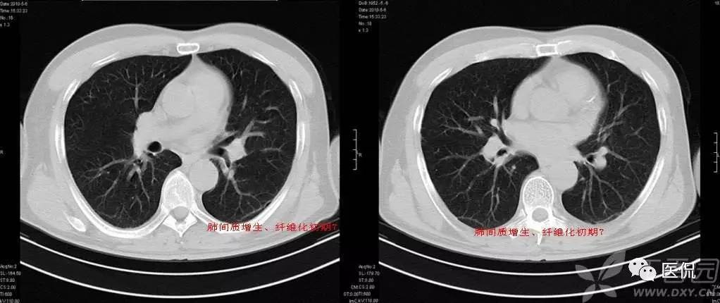 影像学呼吸系统理论知识,呼吸系统疾病影像学常见征象