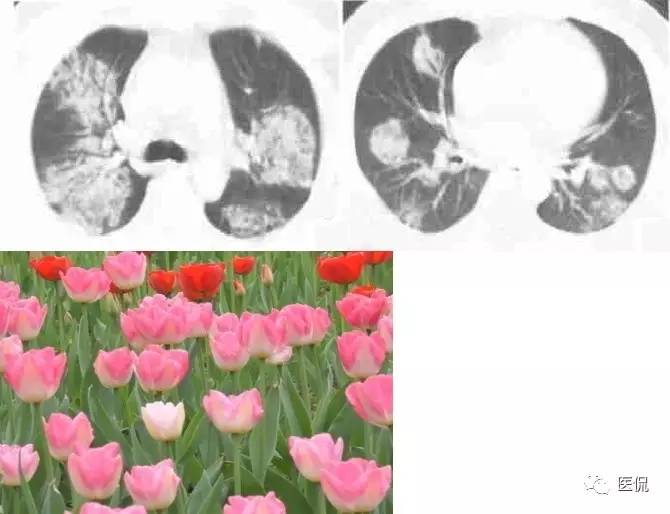 影像学呼吸系统理论知识,呼吸系统疾病影像学常见征象