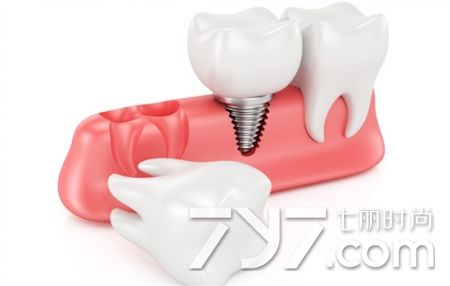 拔牙后注意事项最全,拔牙后注意事项全知道