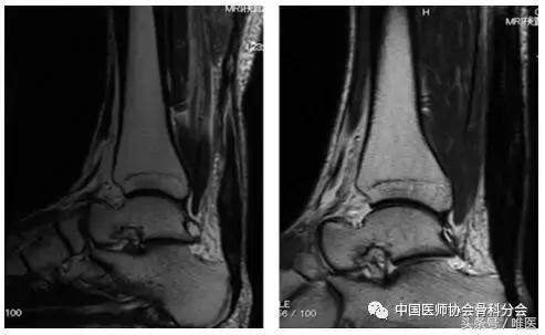 陈旧性跟腱断裂手术修复方法,跟腱断裂陈旧