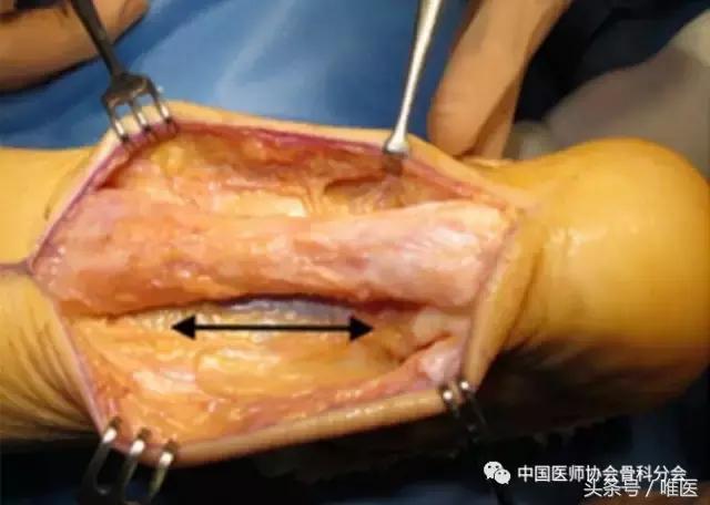 陈旧性跟腱断裂手术修复方法,跟腱断裂陈旧