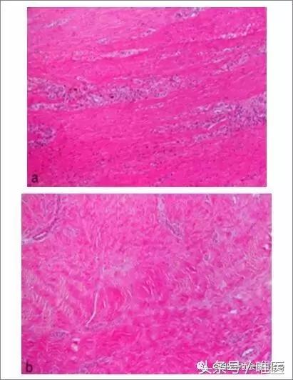 陈旧性跟腱断裂手术修复方法,跟腱断裂陈旧