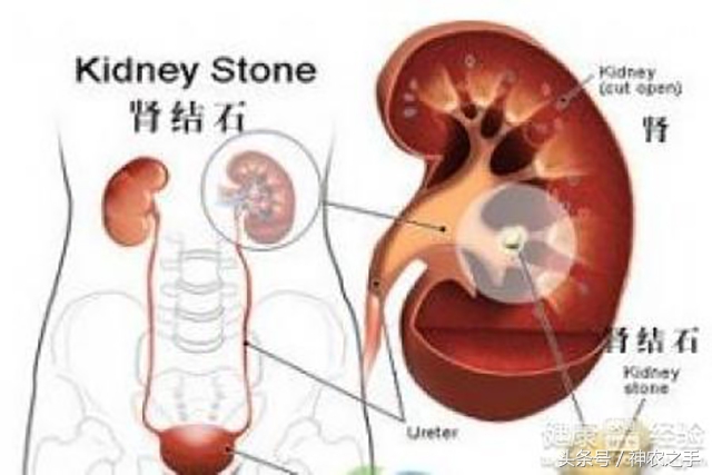 补钙过量会造成肾结石吗,儿童补钙容易得肾结石吗