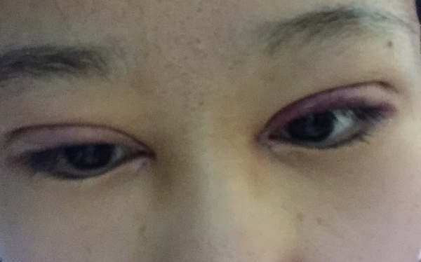 双眼皮手术第五天碰到水怎么办,双眼皮手术前感冒了怎么办