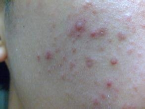 长痘痘怎么办快速消痘男士,长痘痘期间该吃什么可以消除痘痘