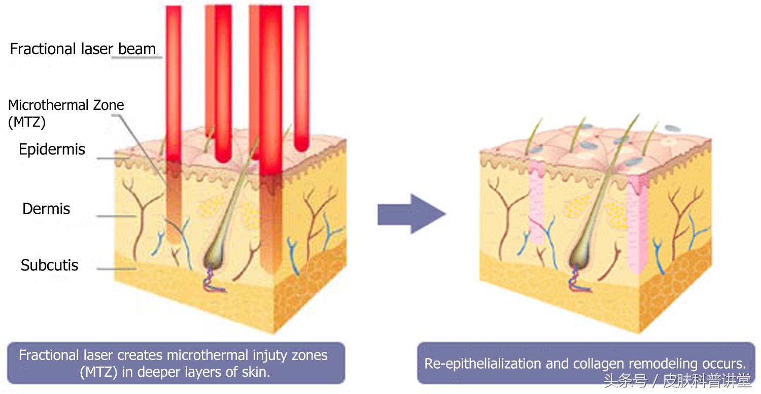 皮肤科鼻子毛孔粗大黑头怎么解决,黑头毛孔粗大出油皮肤科解决方法