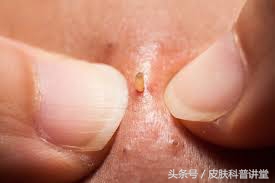 皮肤科鼻子毛孔粗大黑头怎么解决,黑头毛孔粗大出油皮肤科解决方法