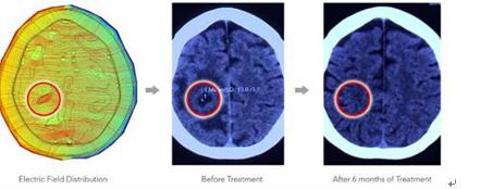 脑胶质瘤电场治疗中还有放疗吗,脑胶质母细胞瘤可否行电场治疗
