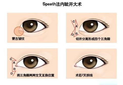 开眼角手术会减轻细纹吗,开眼角会让人显得更成熟吗