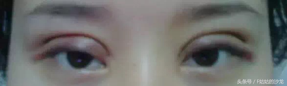 纳米无痕双眼皮的线有点红,纳米无痕双眼皮操作全过程