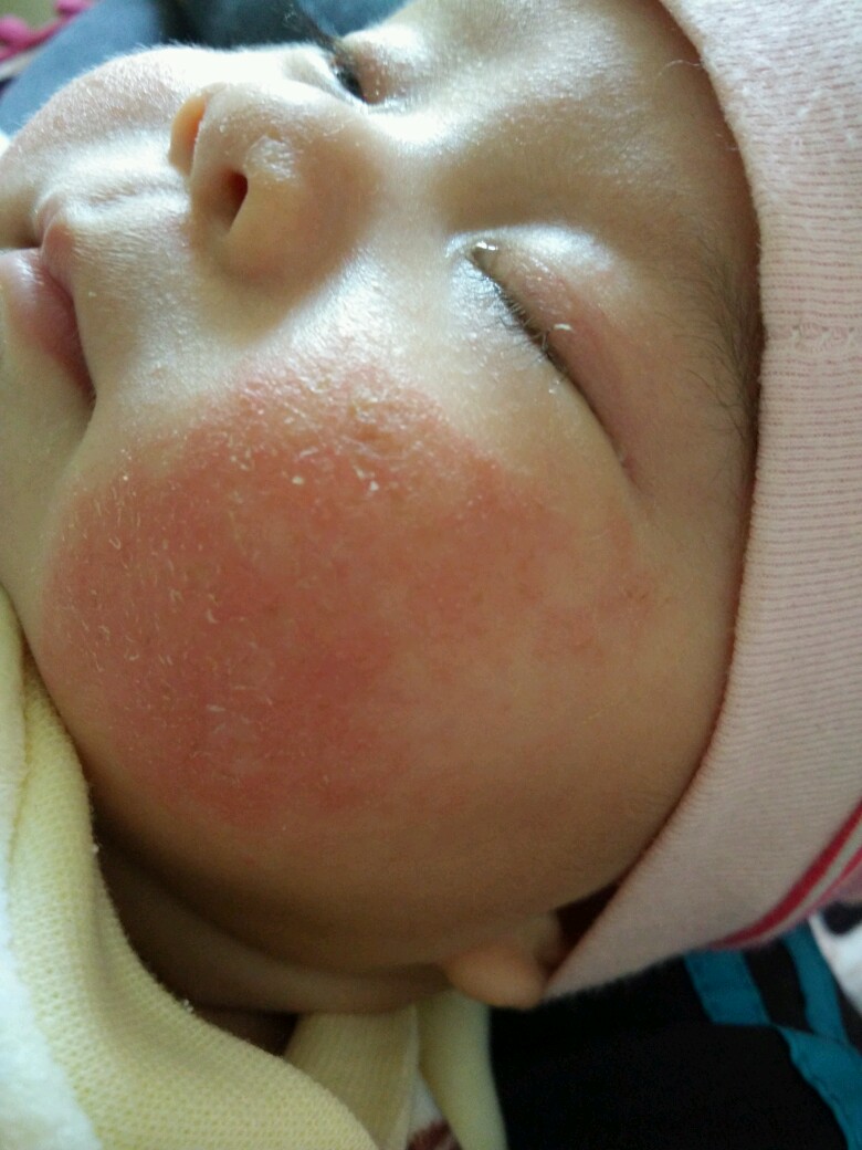 秋冬季节如何保护宝宝的皮肤,儿童冬天怎么保护皮肤