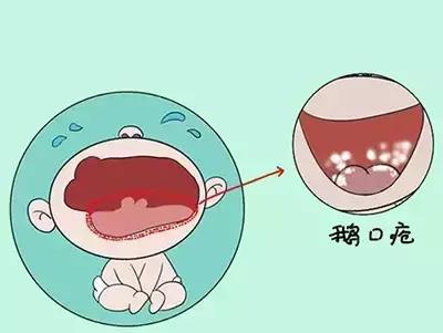 鹅鹅鹅鹅口疮,你需要知道这些