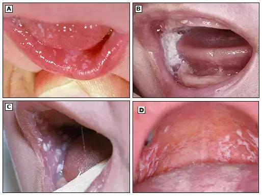 鹅鹅鹅鹅口疮,你需要知道这些
