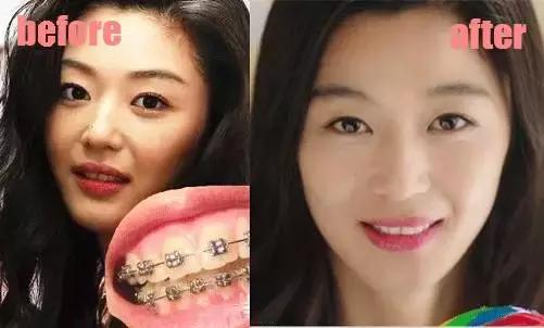 整牙=整容？看杨幂、刘涛、高圆圆为你亲身示范！