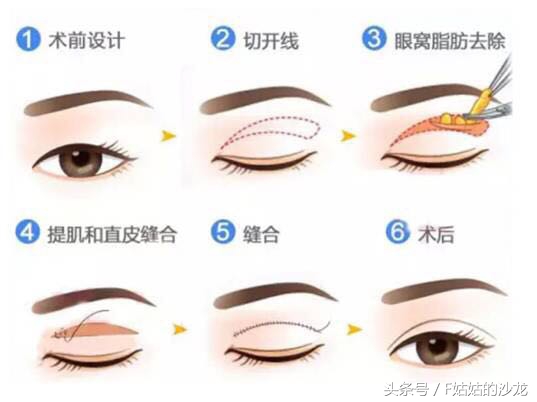 纳米无痕双眼皮的线有点红,纳米无痕双眼皮操作全过程