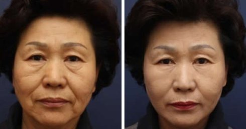 鼻子整形保质期多久,整形维护期大概是多久