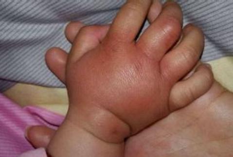 三岁宝宝接触到过敏源导致脸肿,孩子吃了啥过敏发红疹怎么办