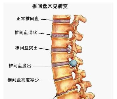 腰椎间盘突出护理方法,腰椎间盘突出如何保养调理