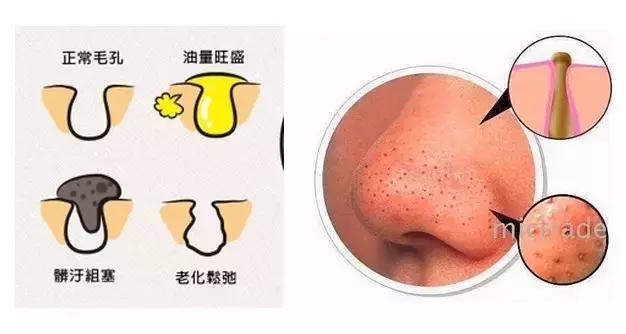 拒绝草莓鼻，如何正确去黑头这些你要知道！