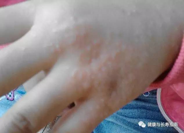 儿童手上起水泡痒脱皮用什么药膏,脚底起小水泡又痒又脱皮反反复复