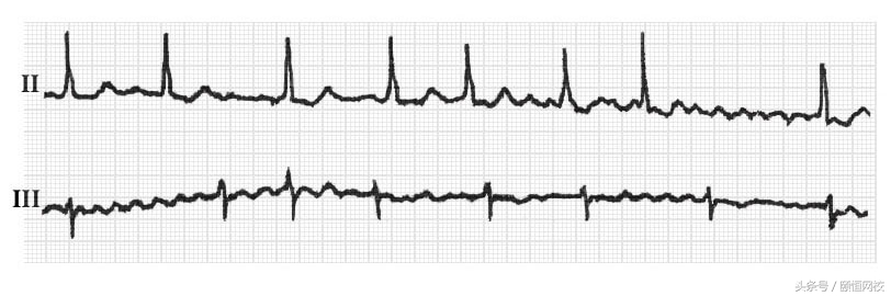郭雅卿心电图讲解全集,郭雅卿心血管视频课