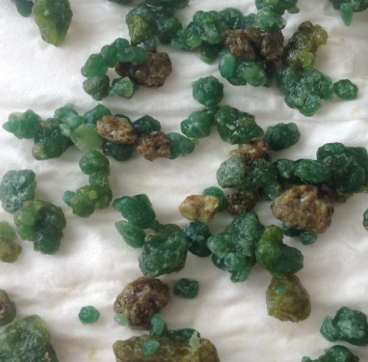 这就是肝脏结石！看完是不是觉得挺恐怖的？