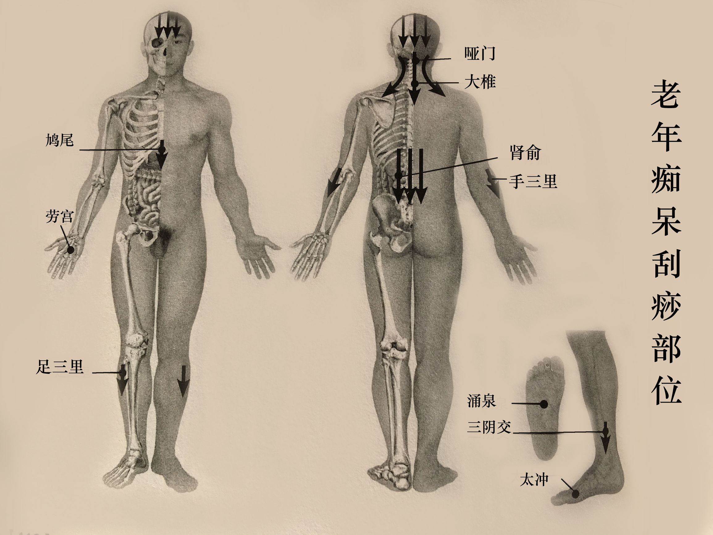 脑血栓患者可以做头部刮痧吗,脑动脉硬化的中医治疗