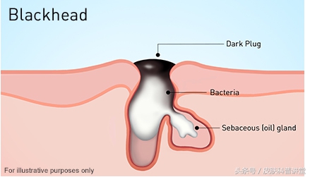 皮肤科鼻子毛孔粗大黑头怎么解决,黑头毛孔粗大出油皮肤科解决方法