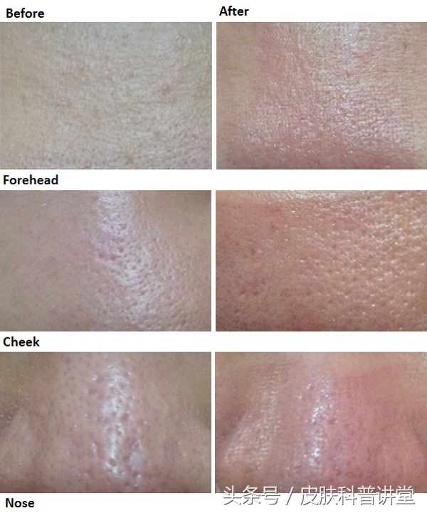 皮肤科鼻子毛孔粗大黑头怎么解决,黑头毛孔粗大出油皮肤科解决方法