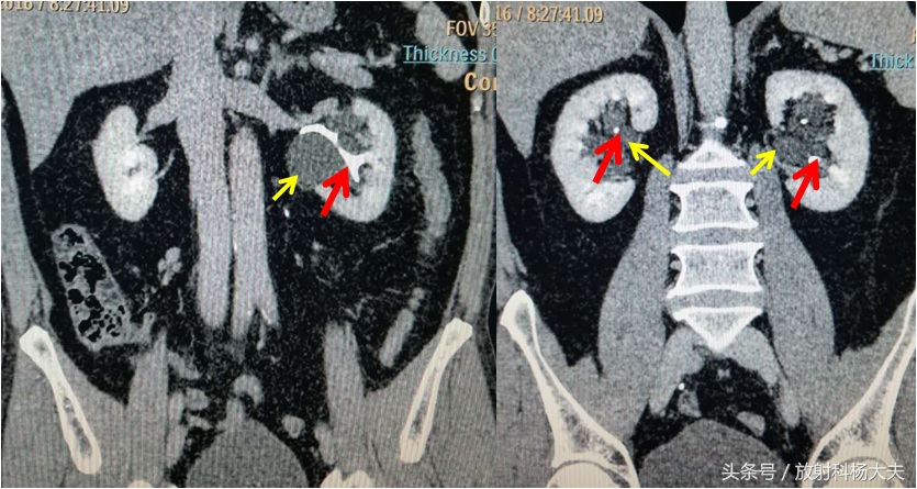 b超检查有肾积水ct为啥没查出来,ct显示左肾积水