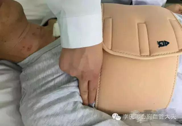 心脏搭桥术后康复和注意事项,心脏搭桥术后可能存在的问题