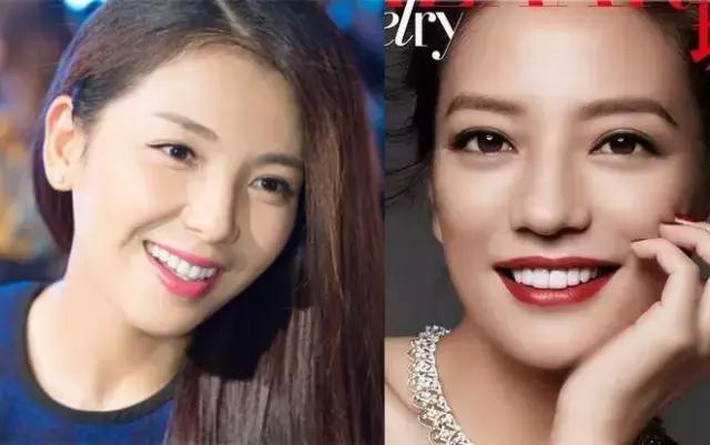 整牙=整容？看杨幂、刘涛、高圆圆为你亲身示范！